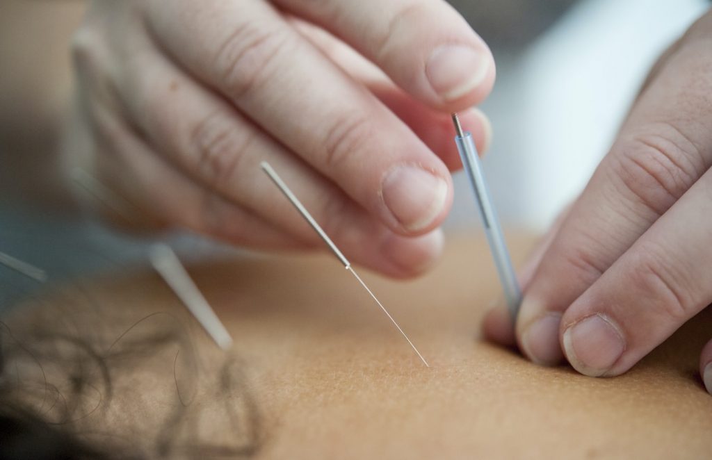 Acupuncture therapy 